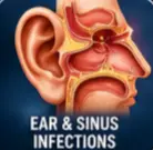 Co Amoxiclave fo ENT Infections 
