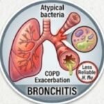 What Is Erythromycin Commonly Used For