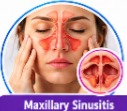 Cefuroxime Uses