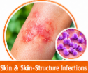 Cefuroxime Uses