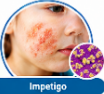 Cefuroxime Uses