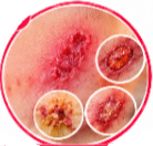 Flucloxacillin (Floxapen) Uses
