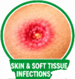 Vancomycin for MRSA, Vancomycin antibiotic, Vancomycin uses, Vancomycin dosing, Vancomycin side effects, Vancomycin mechanism of action