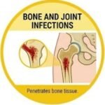 The Imipenem + Cilastatin Story,
Imipenem Cilastatin, Imipenem Cilastatin Injection, Imipenem Cilastatin Uses, Imipenem Cilastatin Side Effects, Imipenem Cilastatin Dosage, Imipenem Cilastatin Mechanism of Action, 