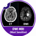 stroke diagnosis, stroke symptoms, stroke tests, stroke diagnosis criteria, how doctors diagnose stroke, stroke emergency tests, stroke blood test, stroke CT scan, stroke MRI, FAST stroke test, ischemic stroke diagnosis