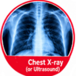 Diagnose Pneumonia, silent pneumonia, walking pneumonia, pneumonia symptoms, chest x-ray pneumonia, pneumonia diagnose test, pneumonia treatment, pneumonia recovery, pneumonia in elderly, pneumonia in kids, atypical pneumonia, viral pneumonia, bacterial pneumonia, pneumonia warning signs, early pneumonia detection, pneumonia misdiagnosis, pneumonia diagnose at home, pneumonia antibiotics