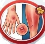 Cefprozil and Vaginal Discomfort, Cefprozil side effects, Cefprozil vaginal itching, Cefprozil yeast infection, Cefprozil antibiotic vaginal, Cefprozil genital itching, Cefprozil vaginal discharge, Cefprozil candidiasis, Cefprozil itching, Cefprozil vaginitis, Cefprozil genital pruritus, Does Cefprozil cause vaginal itching, Cefprozil side effects vaginal itching and discharge,